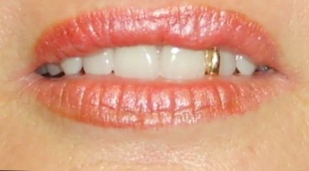 Active Denture Clinic - Dentists Newcastle 8